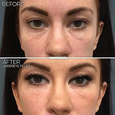 Under eye filler tear trough