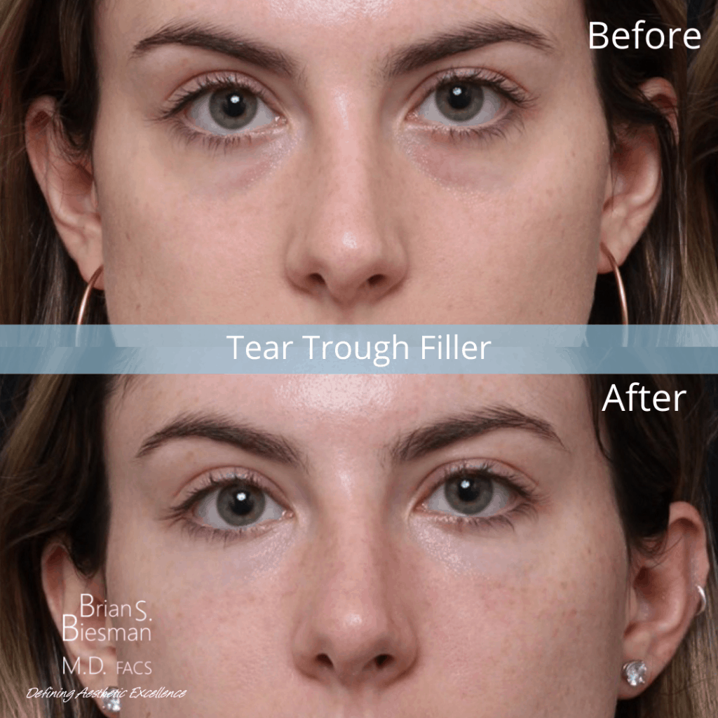 B A Tear rough fillers 1024x1024