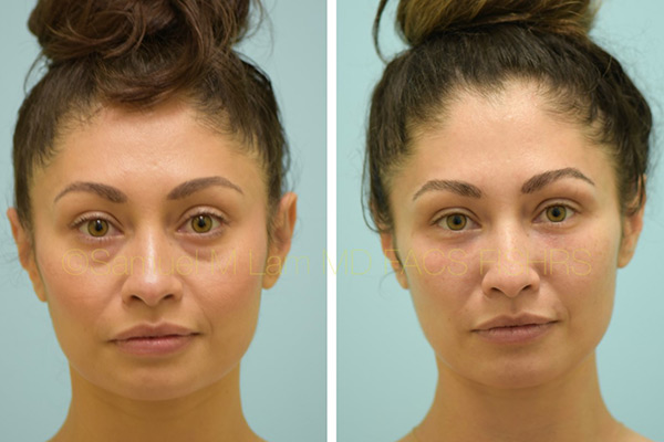 Samlam fat transfer dallas