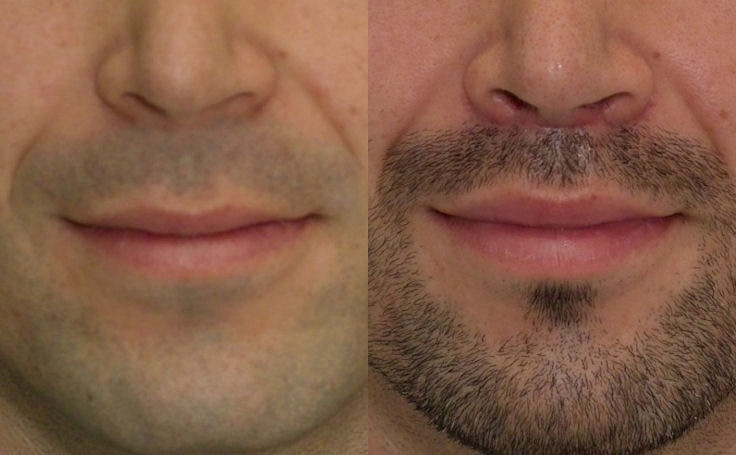 Lip lift male before after f 194