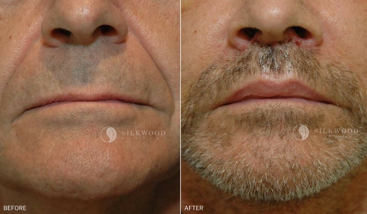Lip lift male dr nettle 1