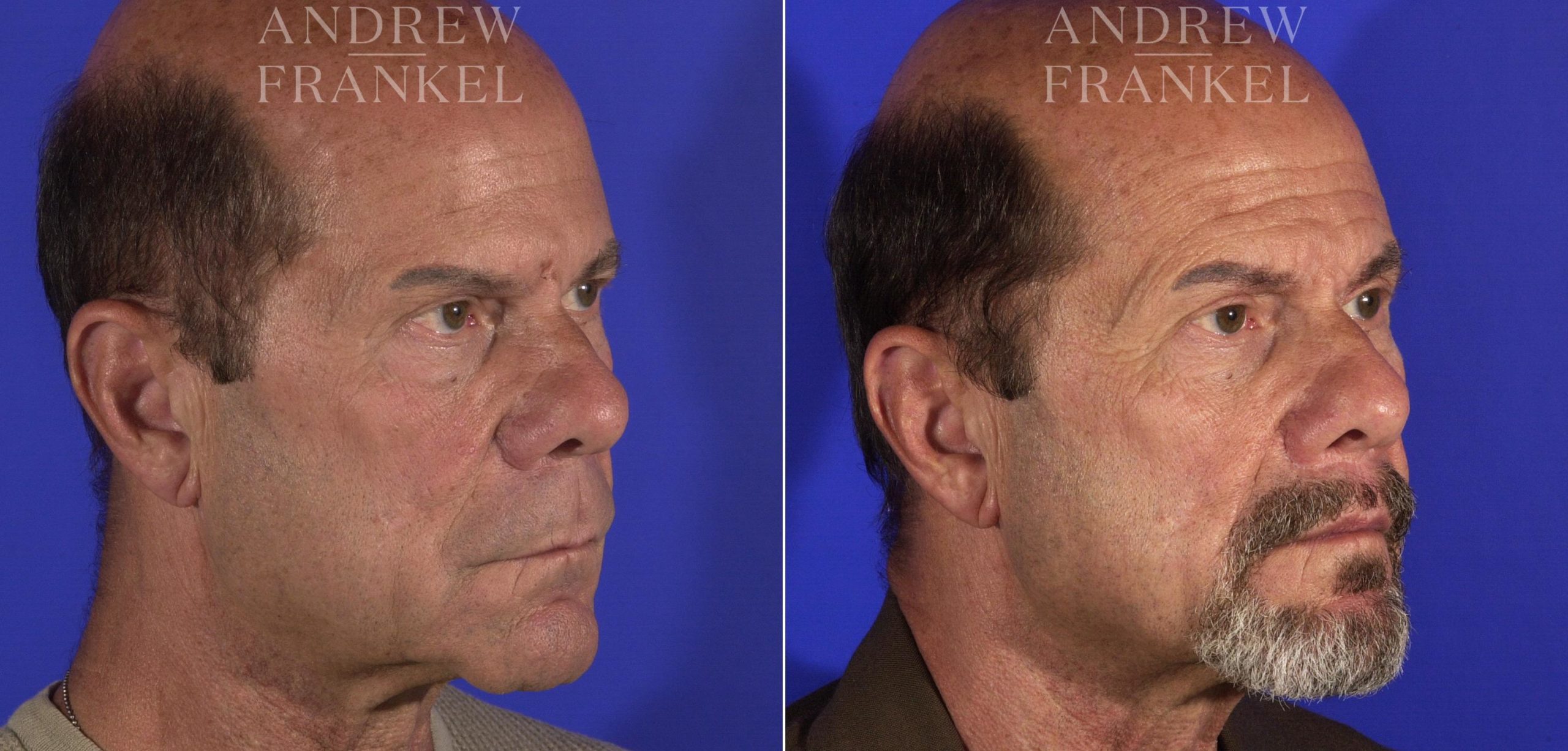 Patient 14219 lip lift before after 4 scaled