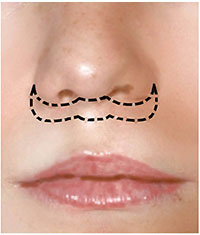 Lip Lift Surgery