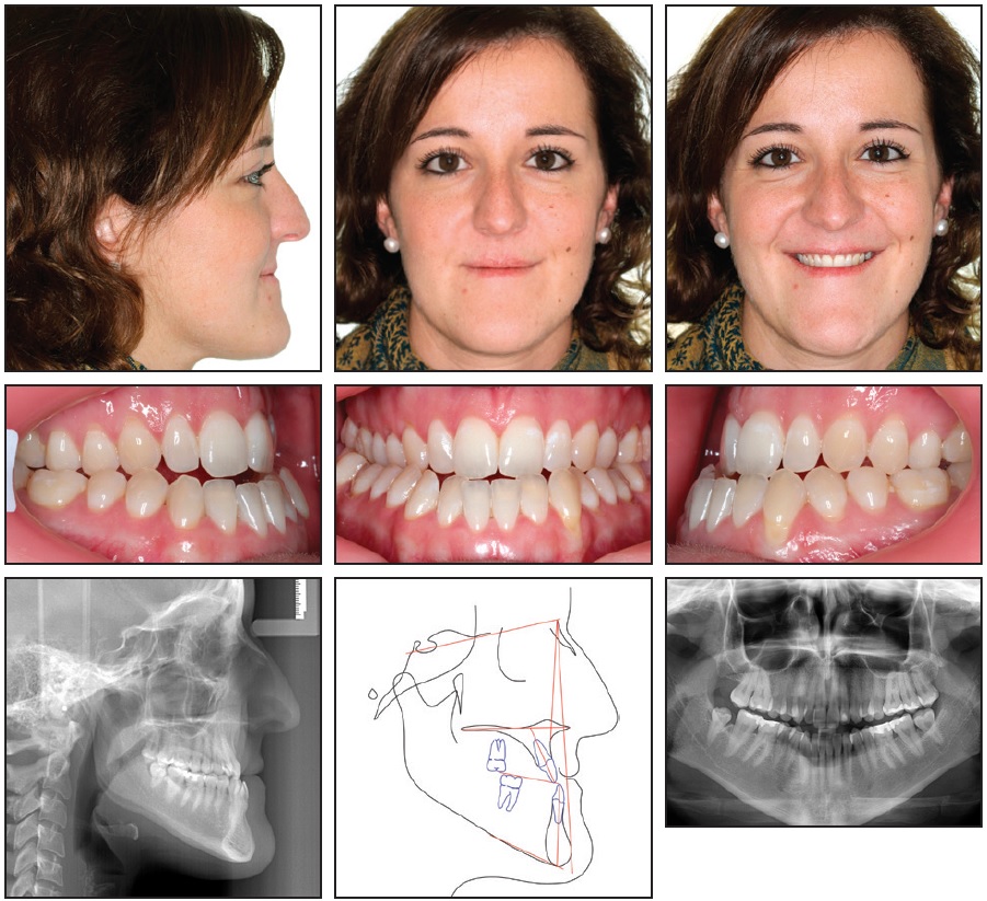 Carriere fig 11