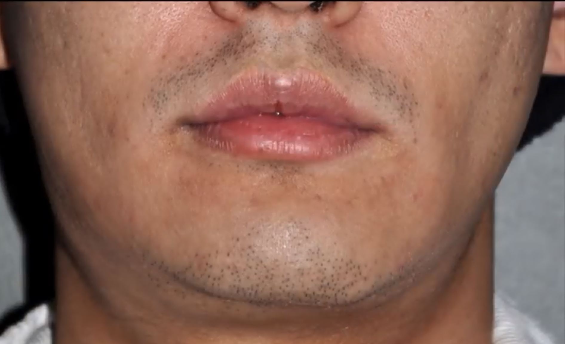 Incel to chad jaw | Looksmax.org - Men's Self-Improvement & Aesthetics