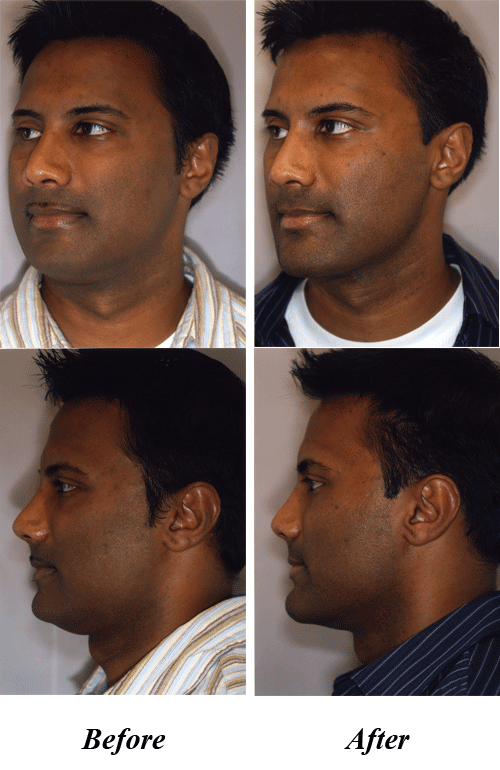Chin implants1 1