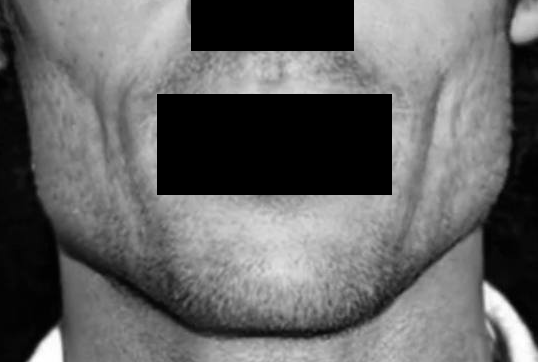 JawB modified