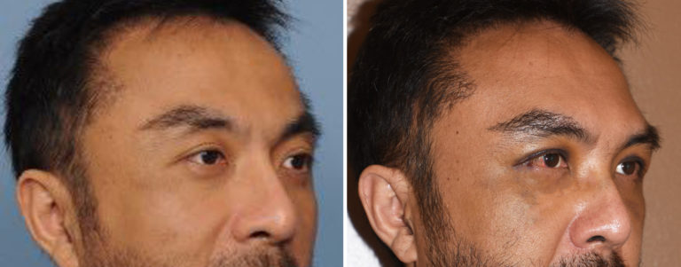 1873438 Male Custom Brow Implant result oblique view Dr Barry Eppley Indianapolis 768x301