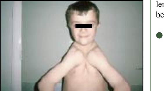 Bilateral missing clavicles a characteristic skeletal abnormality in CCD