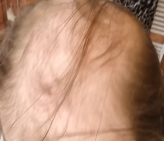 Mature hairline