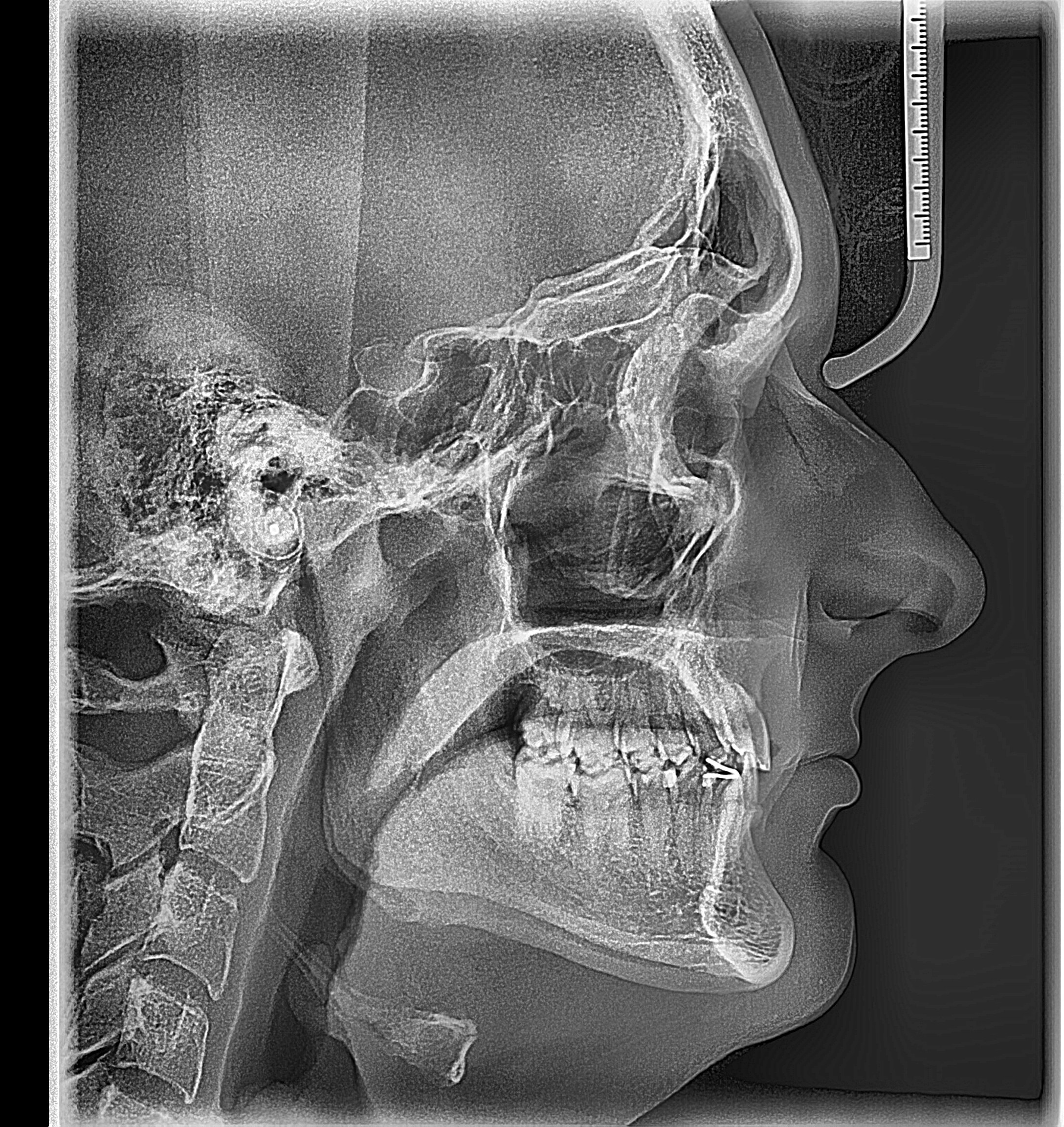 3386366 lateral ceph