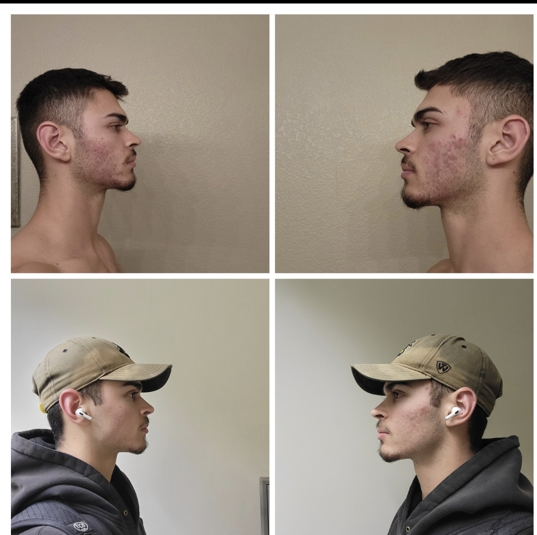 Mewing+skincare GTFIH 1.5 month difference | Looksmax.org - Men's Self ...