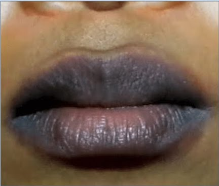 Dark lips