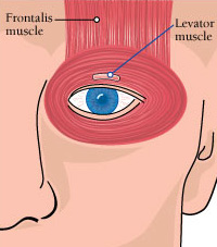 Levator muscle