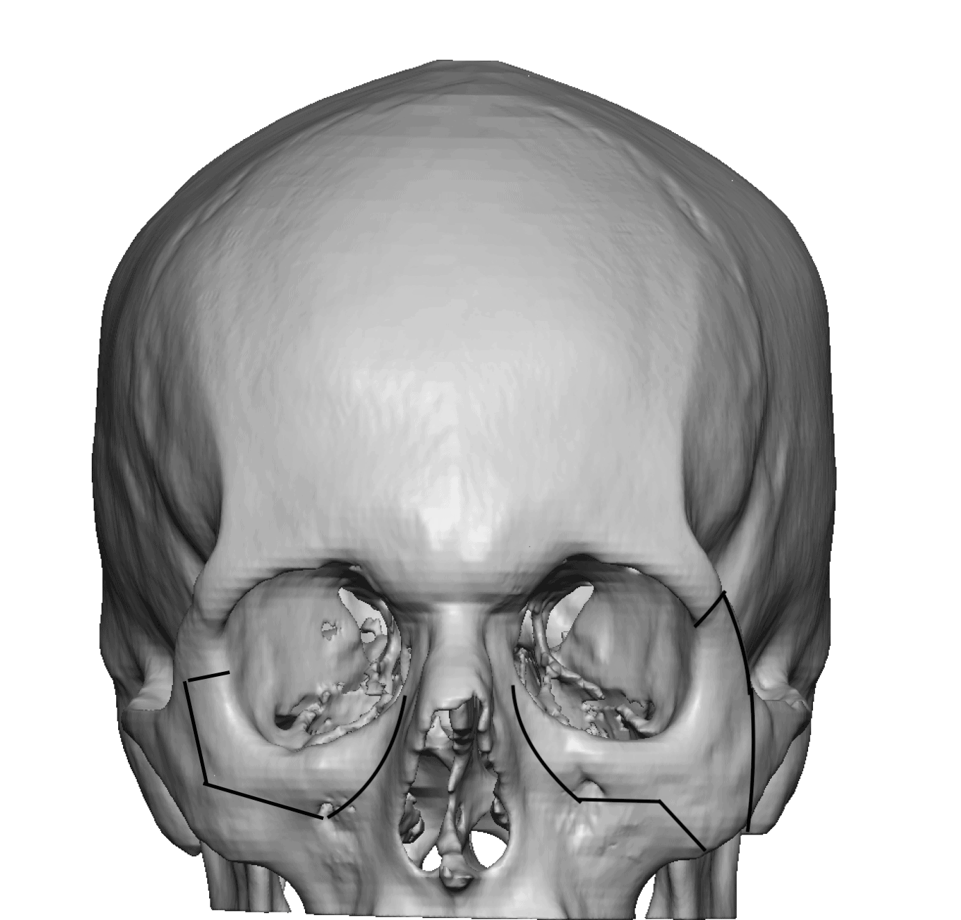 Subcranial 180 degree orbital box osteotomies Dr Barry Eppley 1