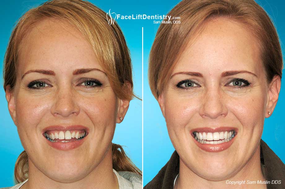 Dental veneers