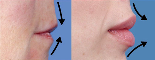 Perfect Lip Projection