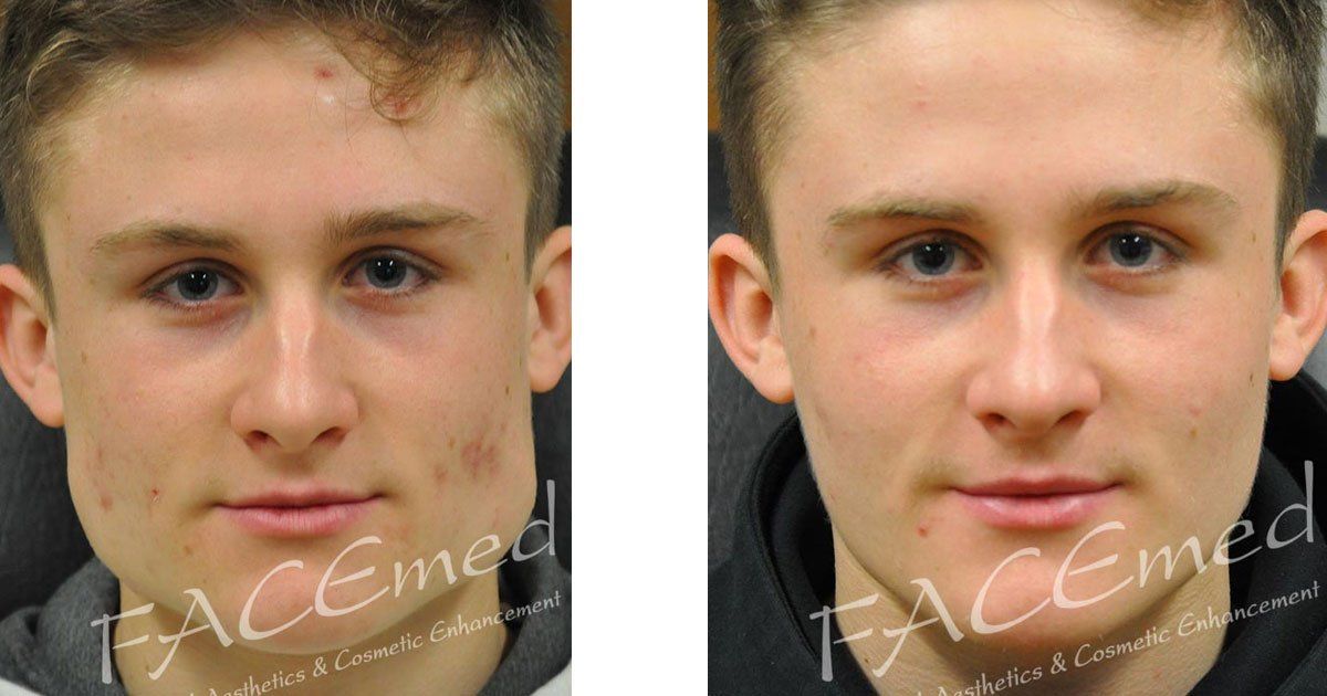 Bruxism before and after