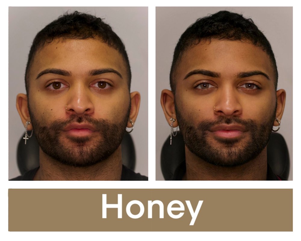 Keratopigmentationpatienteyeswithhoneypigmentbeforeandaftertheprocedure