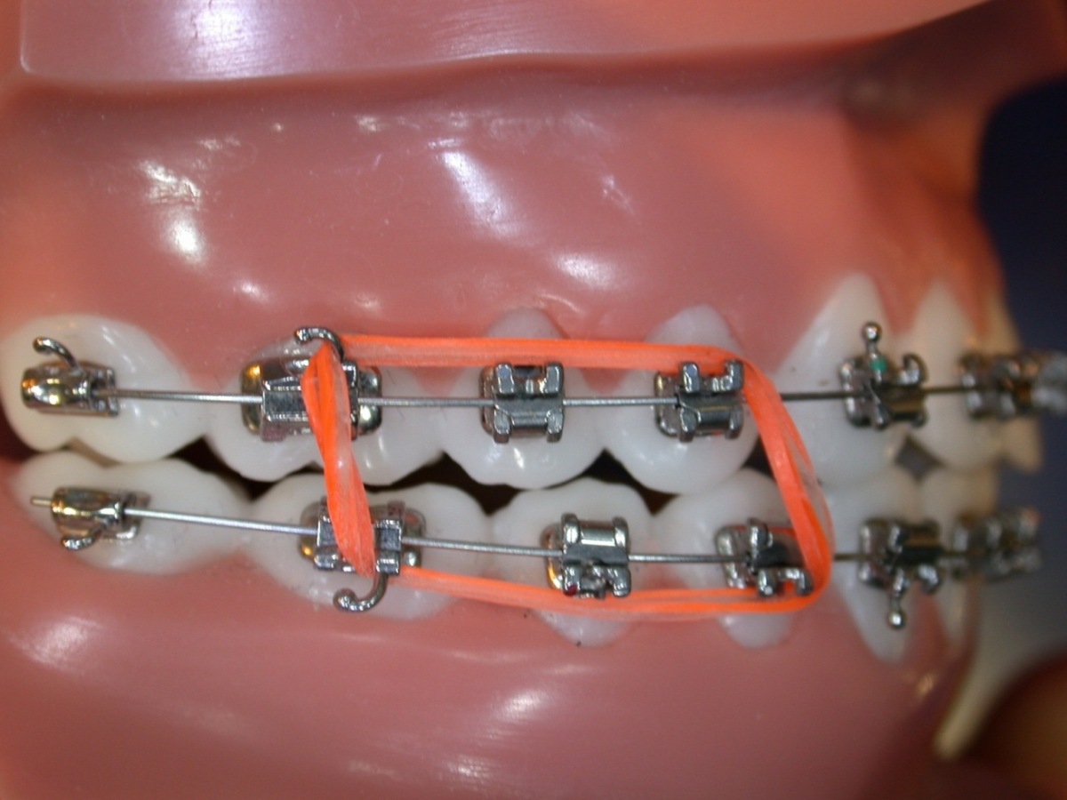 Ortho elastics1
