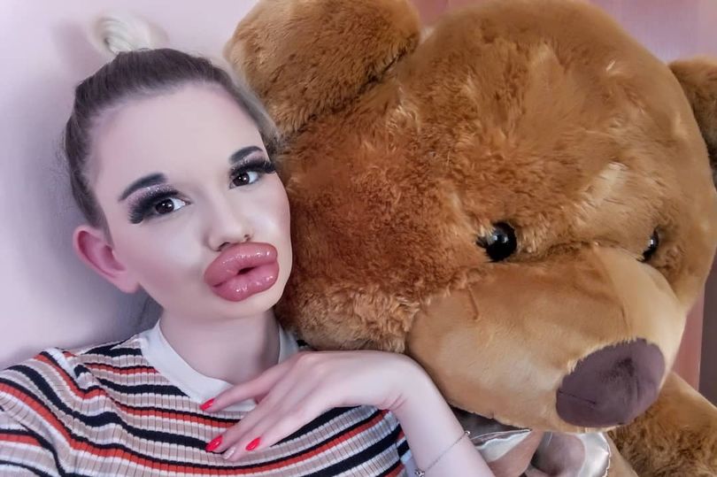 0 Real life Barbie who has spent thousands in an attempt to get the biggest lips in the world 
