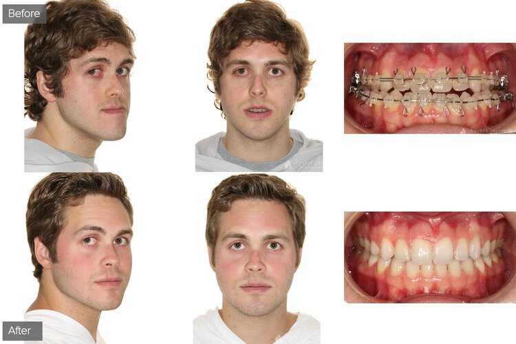 ArnettGunsonBeforeAfterBites17