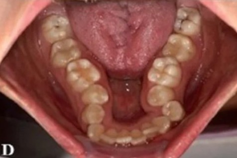 High arched narrow palate with abnormal tooth shape C 1296x728 body2