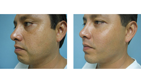 Malar shell implant3