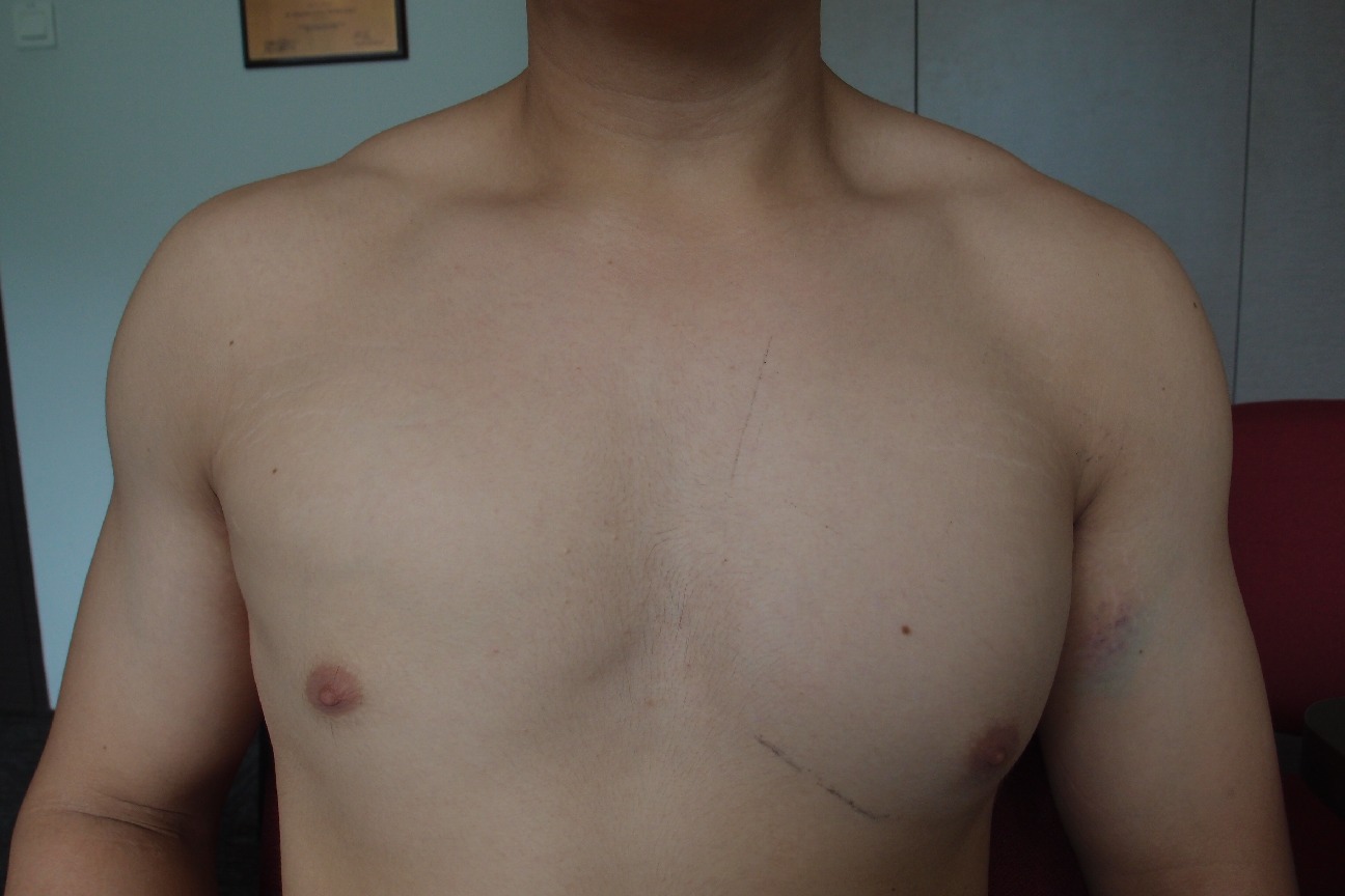 Pectoralis major muscle tear with drooped nipple