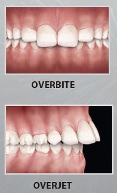 Overjet vs overbite