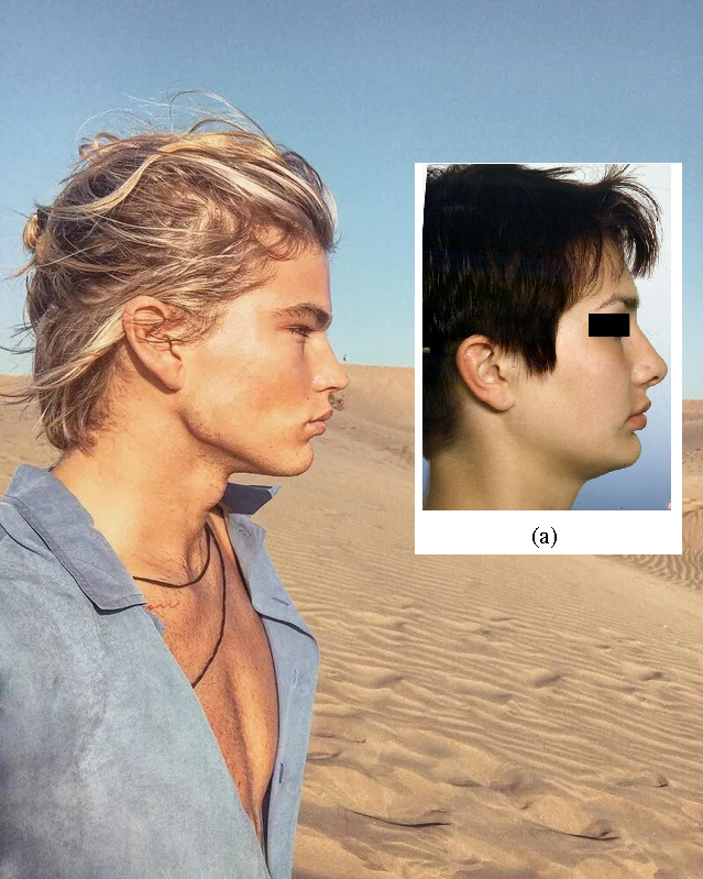 3404790 rate jordan barrett before and after 72 5 facial harmony v0 sk67dkushb3a1