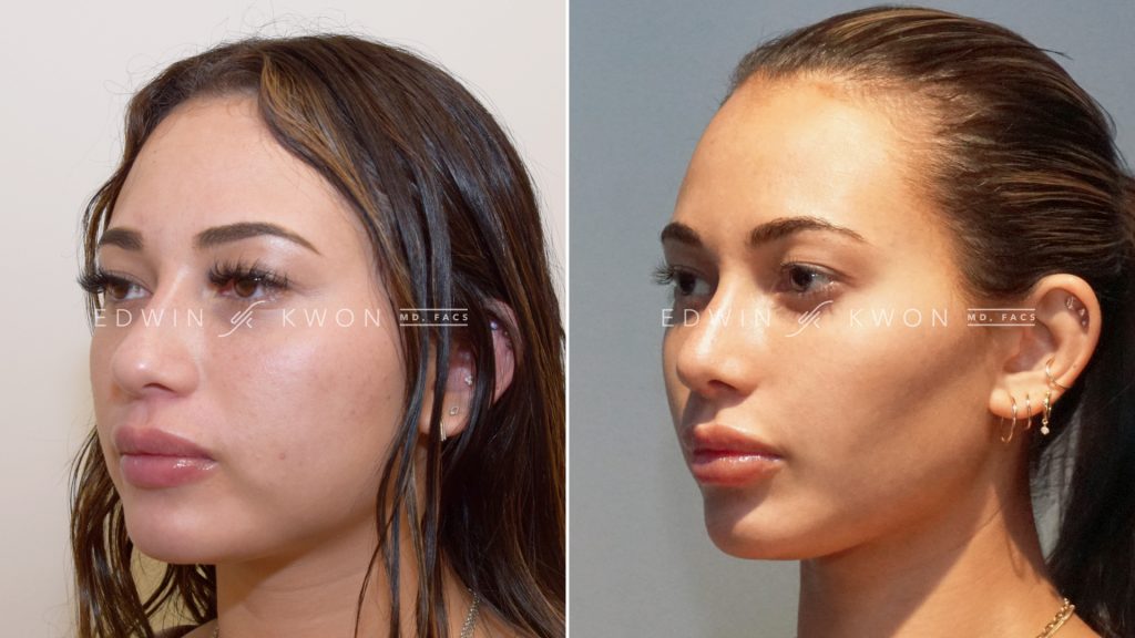 111020 bc buccal fat removal edwin kwon 6mo 02 1 1024x576