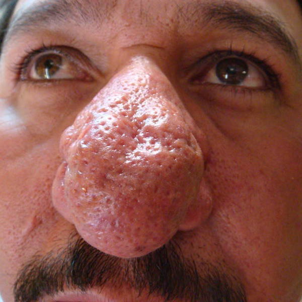 Bulbous Nose Rhinophyma Rosacea