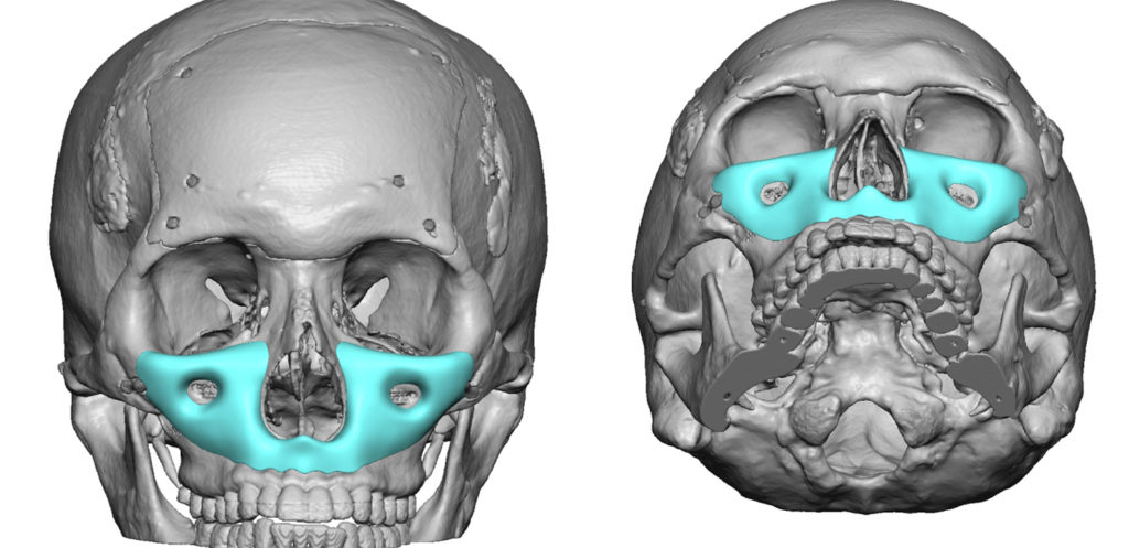 1 Custom total midface implant Dr Barry Eppley 1024x497