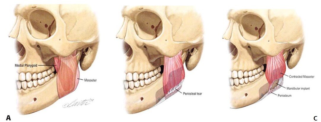 Implant ON Masseter.jpg