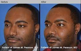 Submalar implant1