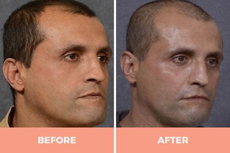 Cheek implants 3