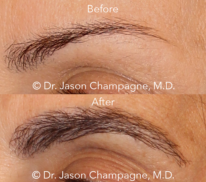 Dr Jason Champagne Eyebrow Transplant Before and After