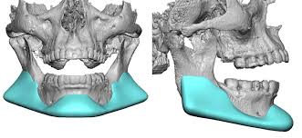 Custom Jawline Implant Replacement for Medporm Implants Dr Barry Eppley Indianapolis