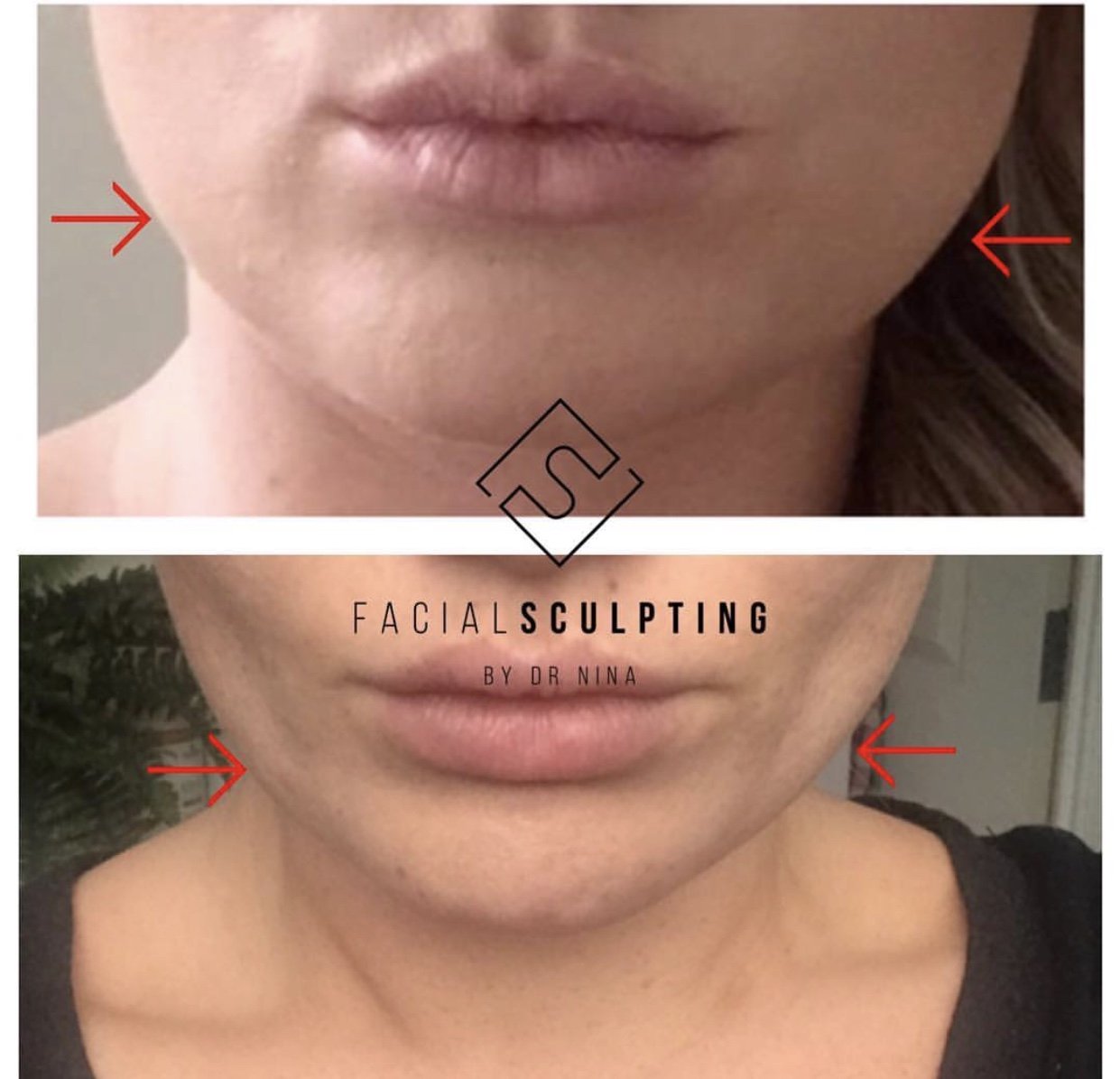 JawlineSlimming
