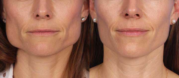 Masseter3 reduction