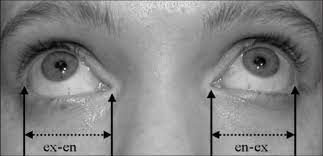 Palpebral fissure length. To measure palpebral fissure length, identify...  | Download Scientific Diagram