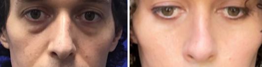 Ffs cheek implant