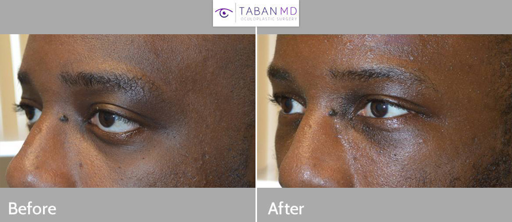 Cosmetic Orbital Decompression Before and After 3 by 4th Left View Patient 2 Dr Taban