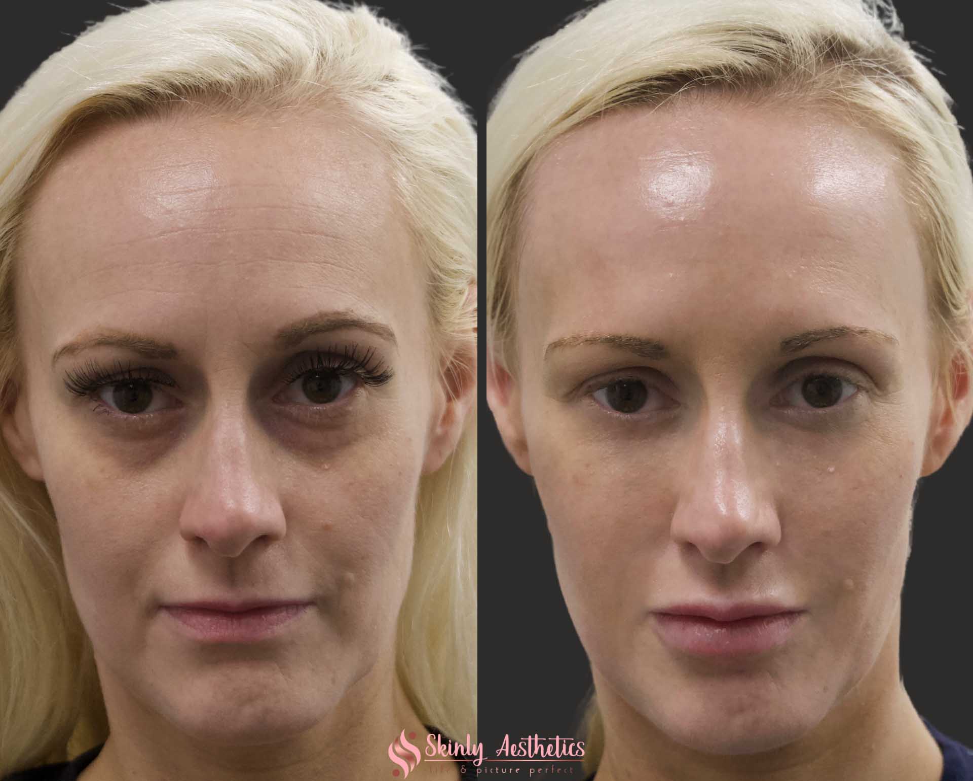 Dark circles under eye treatment