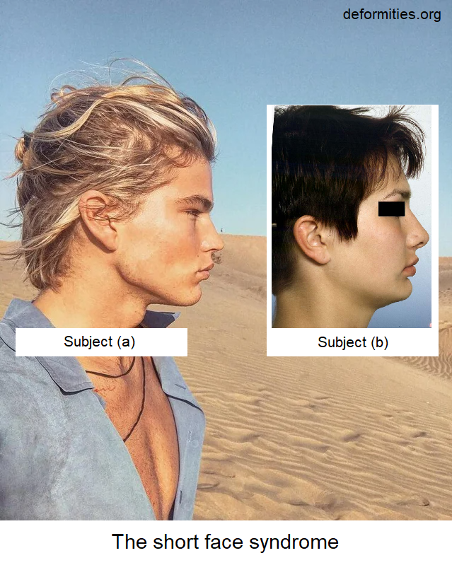 3404790 rate jordan barrett before and after 72 5 facial harmony v0 sk67dkushb3a1