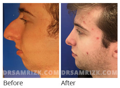 Male rhinoplasty patient 037 1
