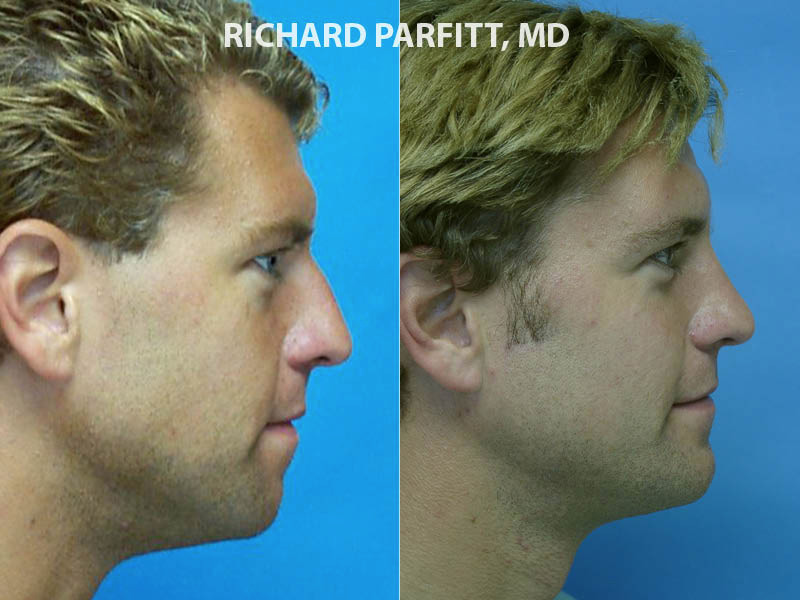 Chin implant WI patient 10