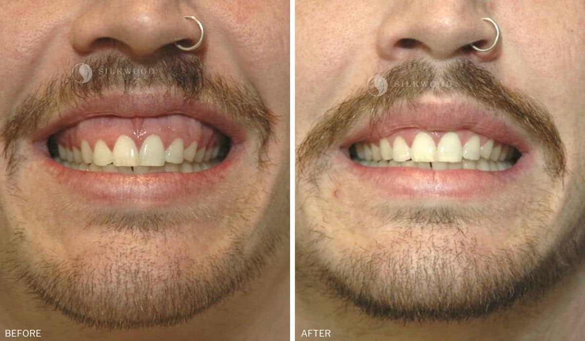 Gummy smile surgery dr warwick nettle