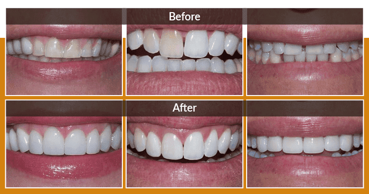 Before after porcelain veneers